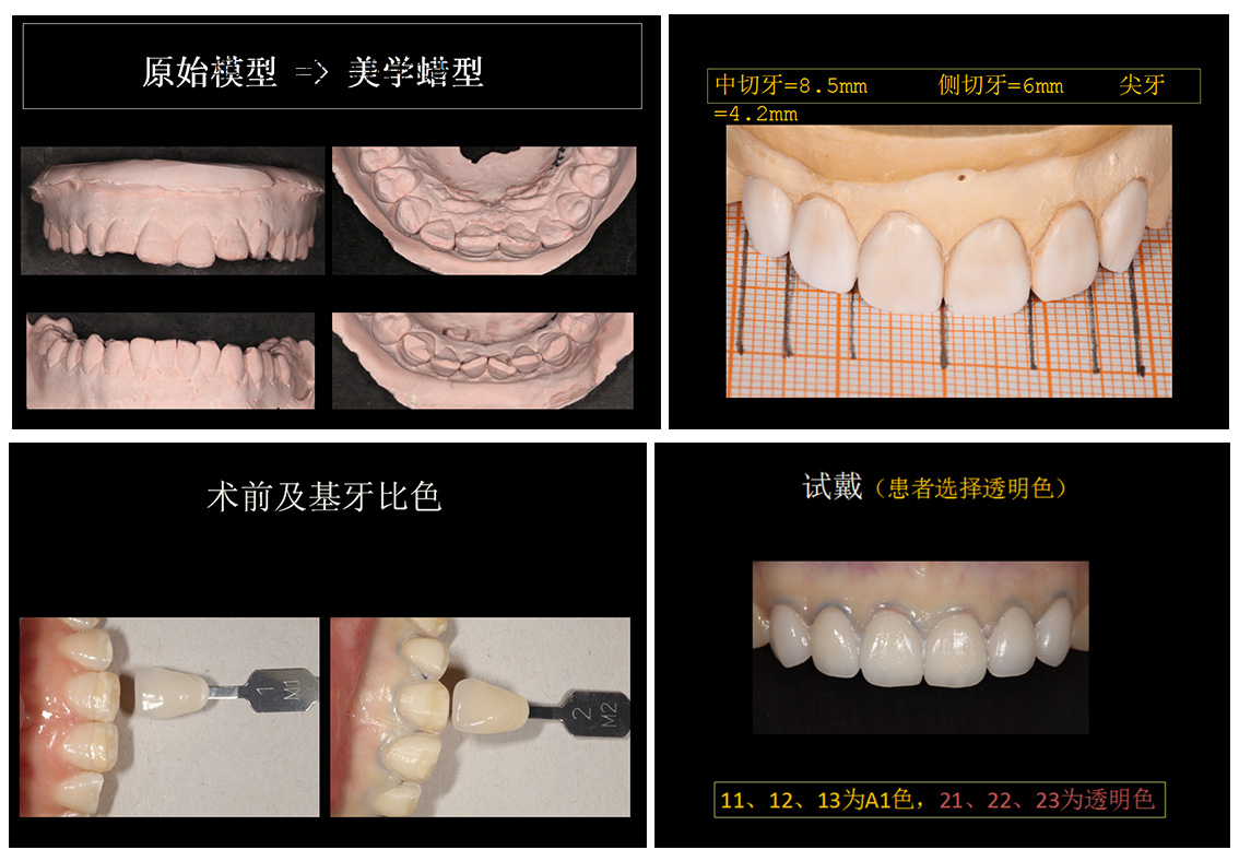 贴面修复案例