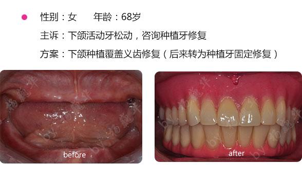 种植牙与真牙有什么区别