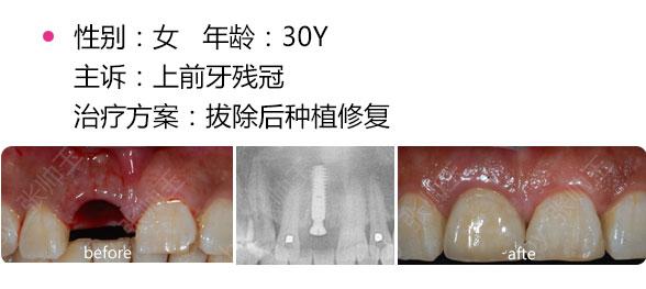 种植牙,种植牙适合人群