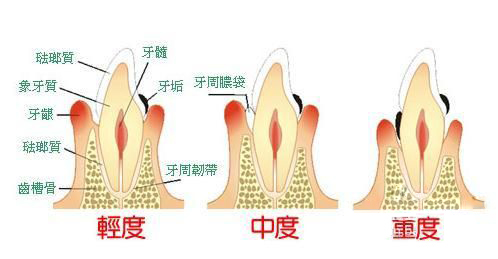 牙周炎可能会引起哪些疾病