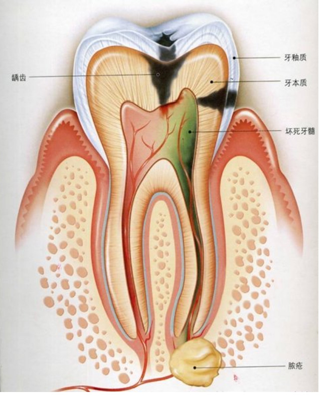 牙髓炎治疗价格贵吗