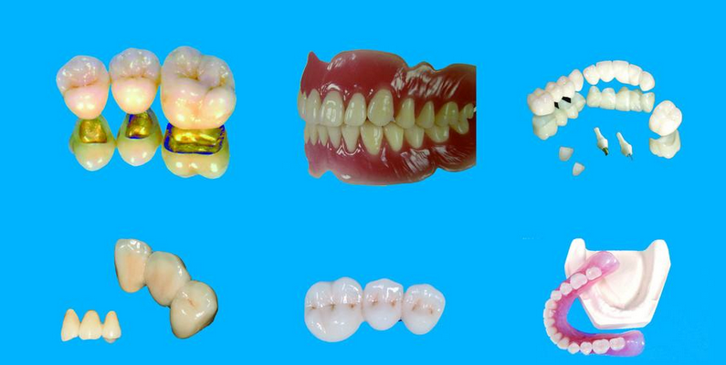 假牙有哪些材料的类型