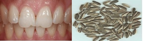 瓜子牙怎么修复方法有哪些