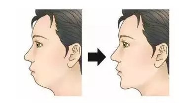 怎么孩子越长越丑?怪牙咯!