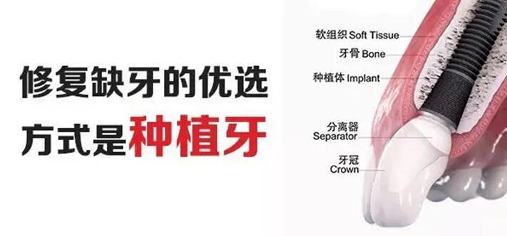 种植牙方式
