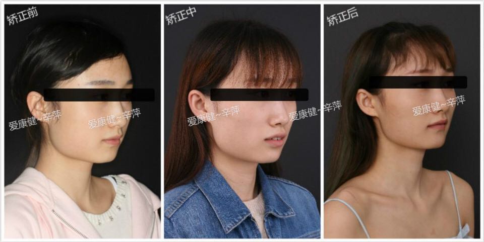 爱康健案例瘦脸:牙齿矫正口腔?v案例可以瘦肚子吗图片