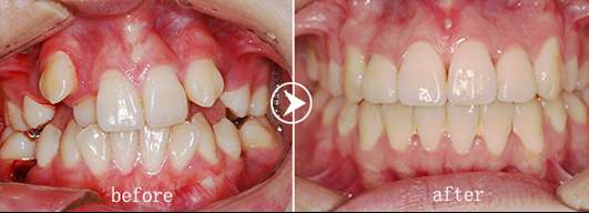 牙齿矫正为什么常常要拔牙？