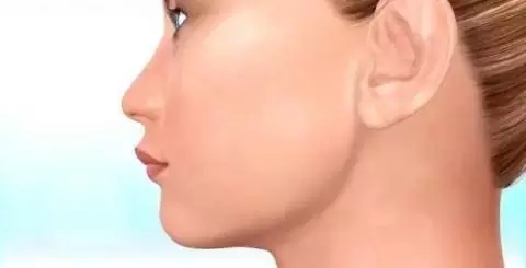 【一图读懂】高晓松拔牙不能瘦脸?那么矫正牙齿瘦脸也是传闻么