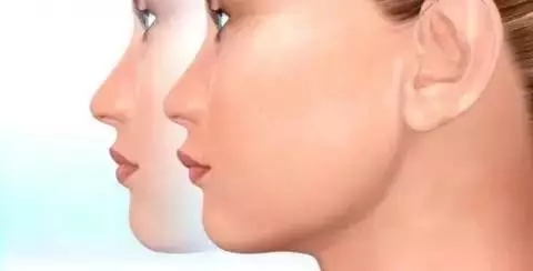 【一图读懂】高晓松拔牙不能瘦脸?那么矫正牙齿瘦脸也是传闻么