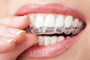 牙齿矫正后要如何护理？