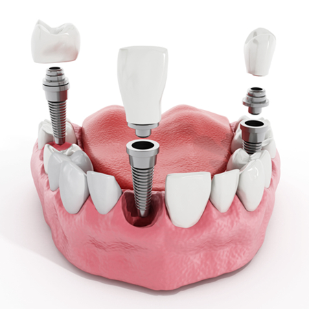 种植牙的过程是怎么样的？种植牙风险高吗？