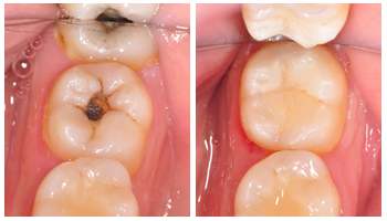 补牙后牙齿能使用多久？