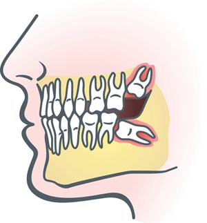 拔牙会造成牙齿松动吗？