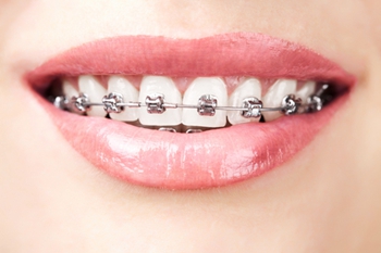 牙齿矫正过程中是否会痛呢？