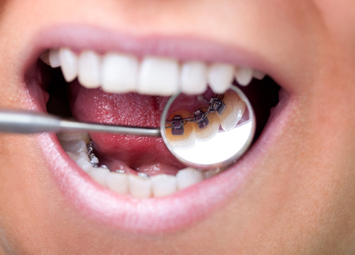 牙齿矫正过程中是否会痛呢？
