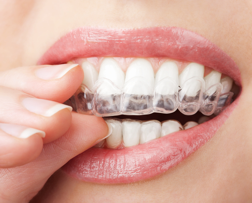 成年人牙齿不齐可以矫正吗？