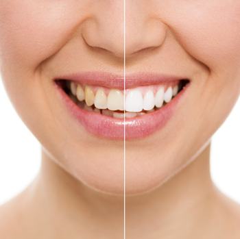哪些牙齿适合做冷光美白？