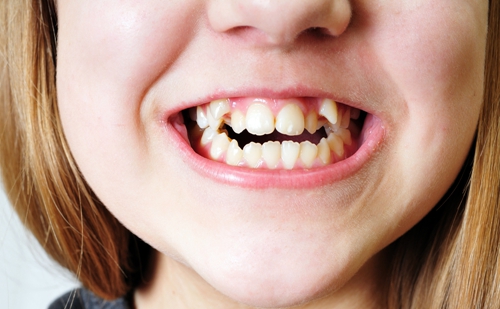 应该如何预防牙齿不齐