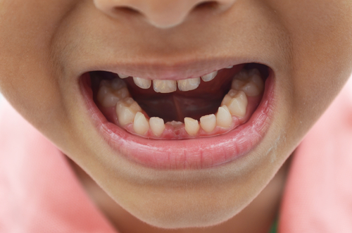 孩子蛀牙的原因有哪些？