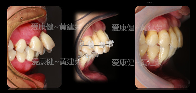 【勇闯上海滩】爱康健齿科集团黄建荣斩获全国口腔病例展评二等奖