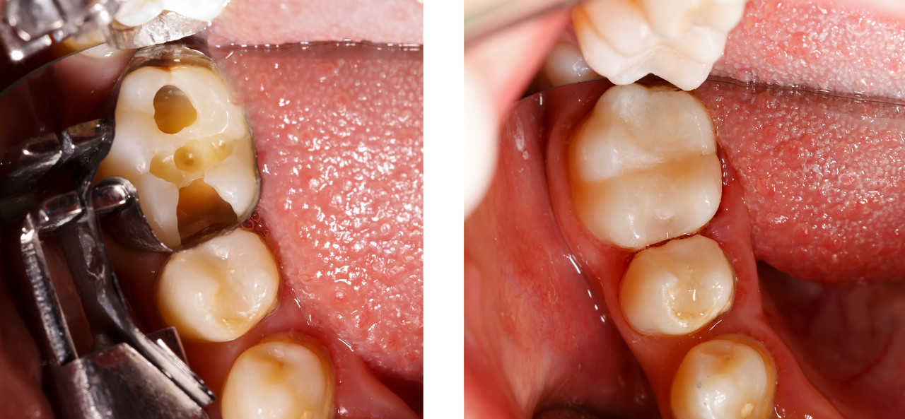 牙齿的哪个部位容易长蛀牙