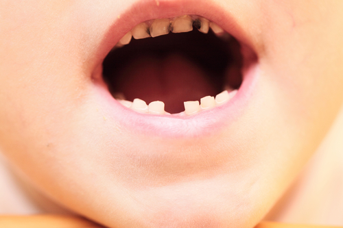 儿童牙齿蛀牙会影响换牙吗