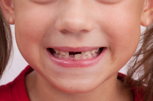 儿童牙齿缺失可以做种植牙吗