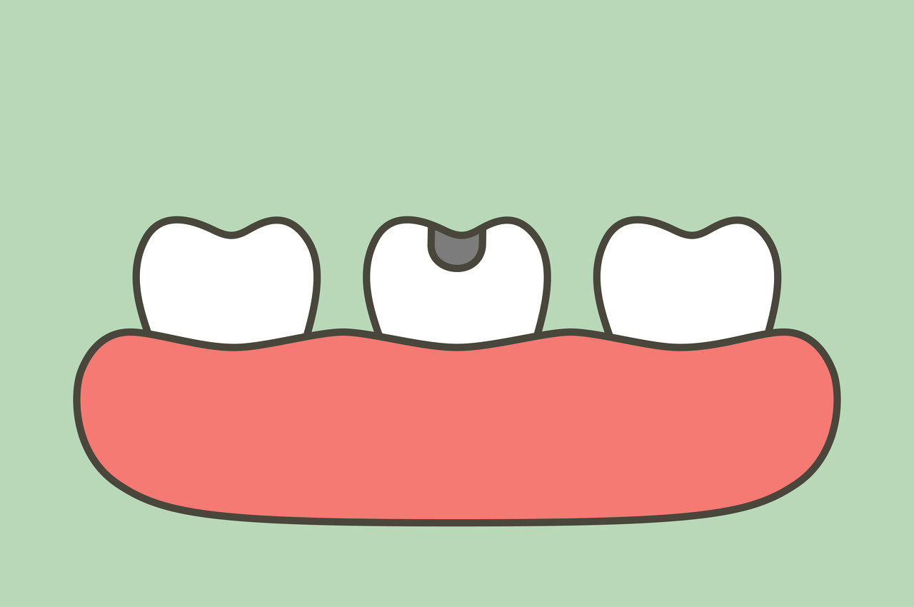 虫牙是真的有虫吗疼怎么办？