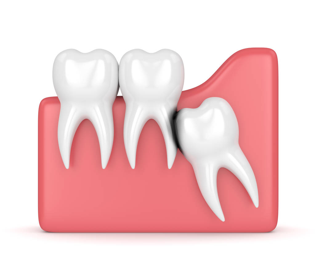 深圳拔智齿牙要多久能恢复？