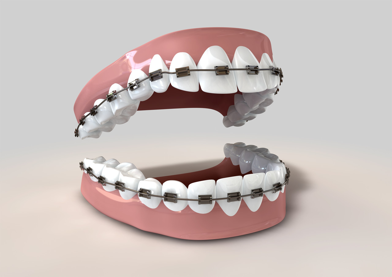 矫正牙齿一般需要多长时间