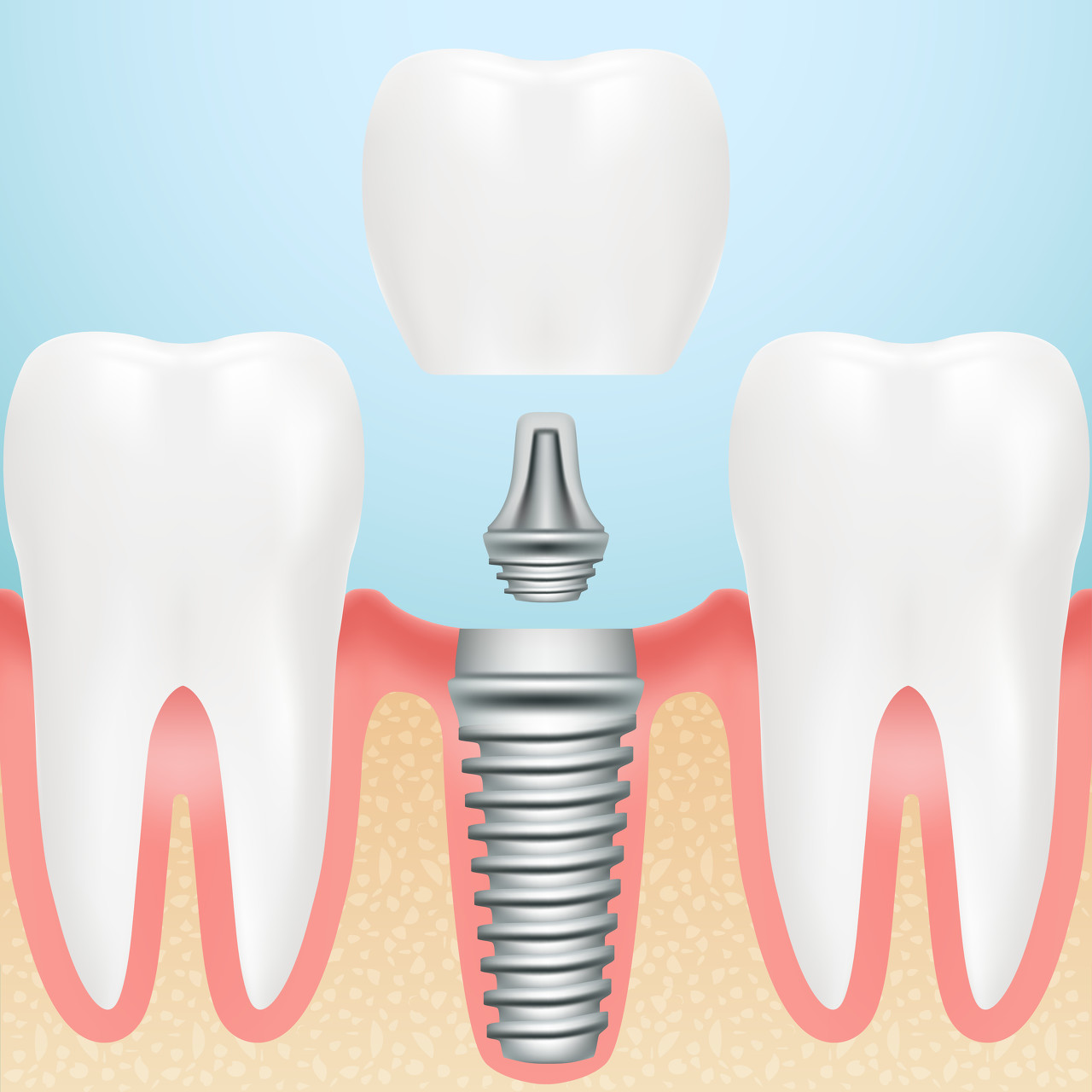 种植牙手术的3大重要流程 - 哔哩哔哩
