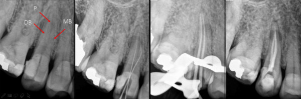 【牙医说第23期】牙齿坏到什么程度，就必须要“杀死神经”？