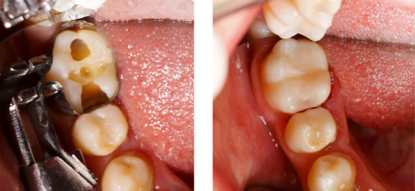 【牙医说第27期】“显微美学”补牙，到底是真“贵族”还是个噱头？