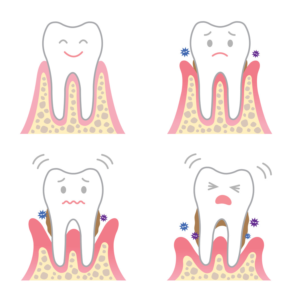 Can You Whiten Veneers?