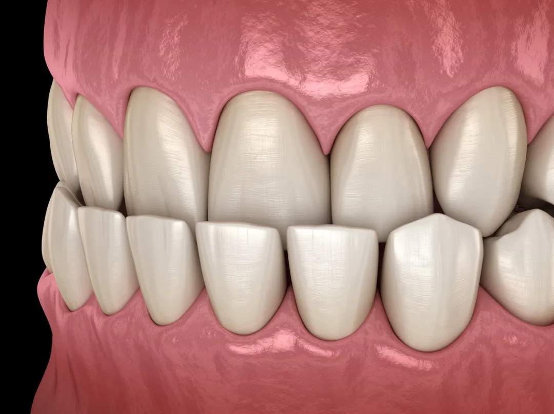 地包天的牙齿矫正方法有哪些_深圳爱康健口腔医院