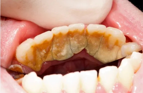【牙医说第92期】只要每天认真刷牙，就不需要定期洗牙了？