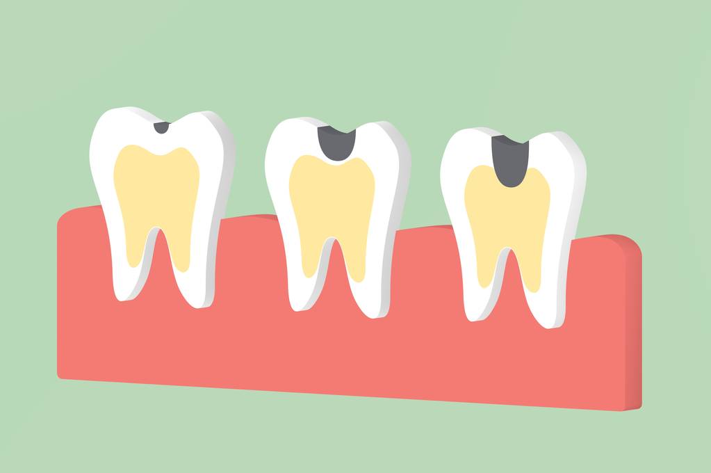 补牙用什么材料好而且坚固？深圳补牙医保可以报销吗？