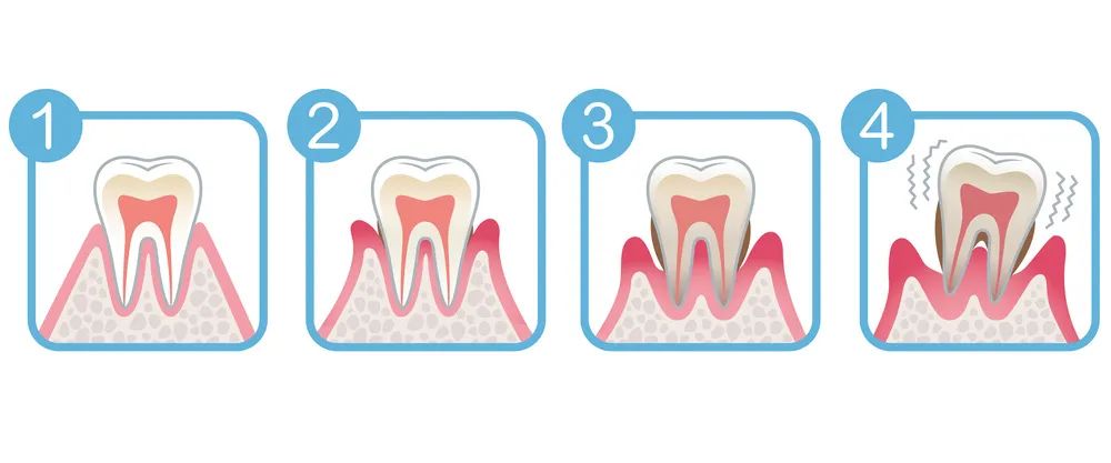 为什么会得牙周炎？深圳爱康健口腔牙周治疗优惠价xian时抢！！！