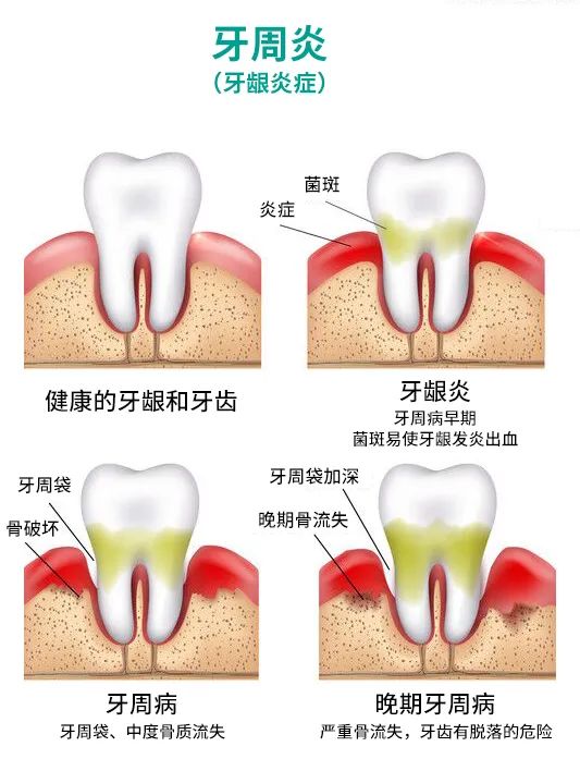 为什么会得牙周炎？深圳爱康健口腔牙周治疗优惠价xian时抢！！！