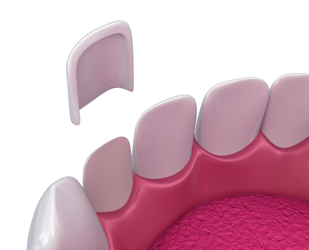 氟斑牙有多少种治疗方法？深圳口腔牙齿美白价格？