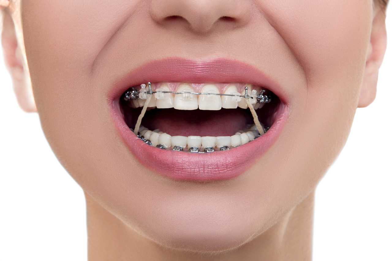 牙齿矫正为什么那么贵？深圳牙齿矫正能用医保吗？