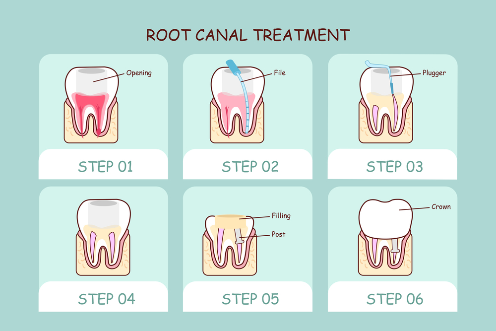 深圳牙齿做根管治疗的步骤和费用