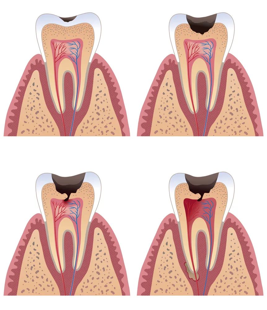 牙齿龋坏到什么程度，就得做根管治疗了？深圳根管治疗哪家好？