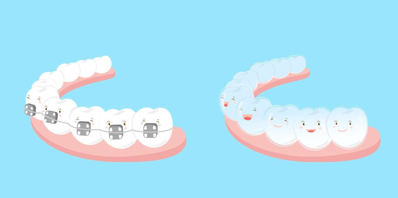 牙齿矫正需要几个阶段？深圳现在牙齿矫正大概多少钱？