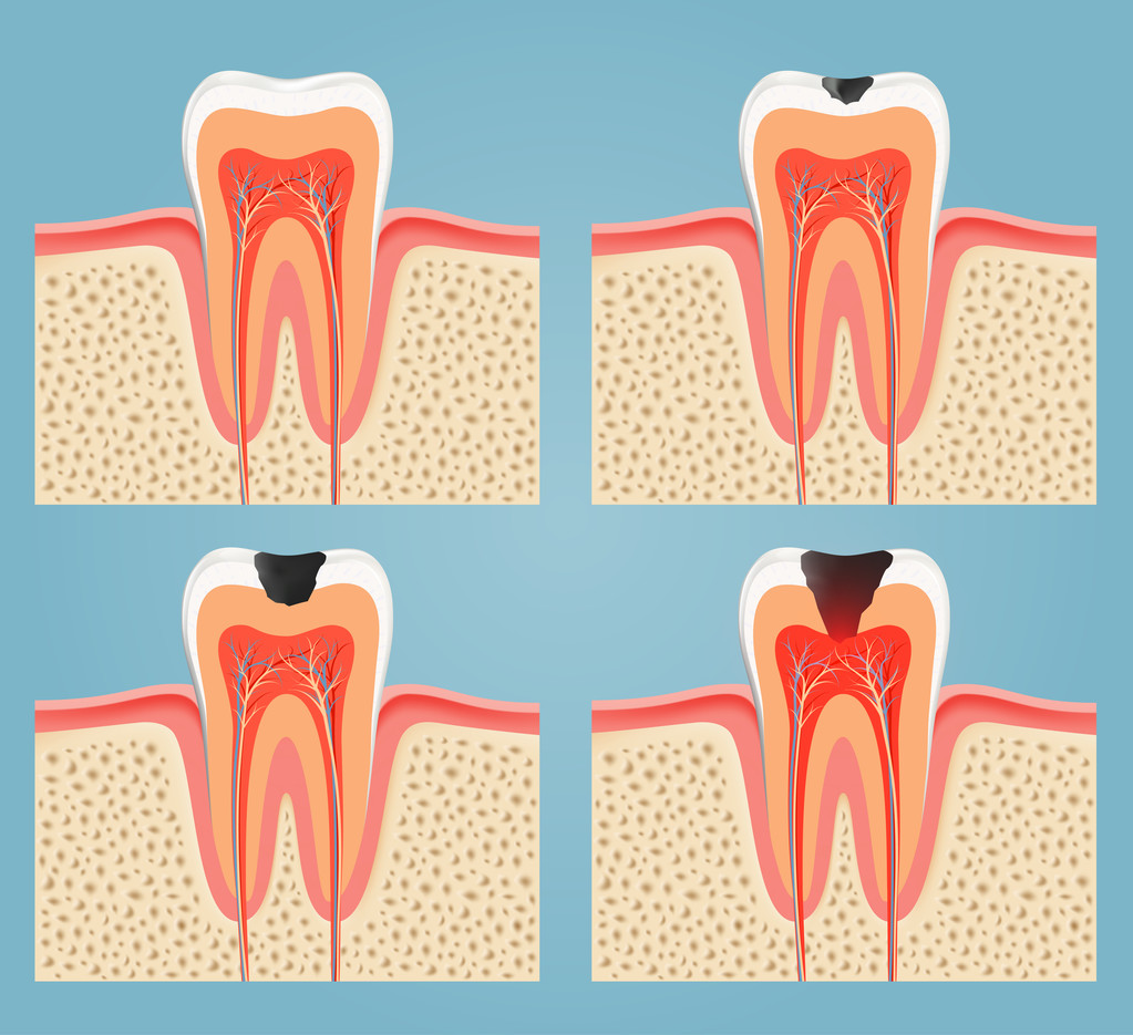 牙齿有黑点是蛀牙吗？深圳牙齿有洞补牙多少钱？