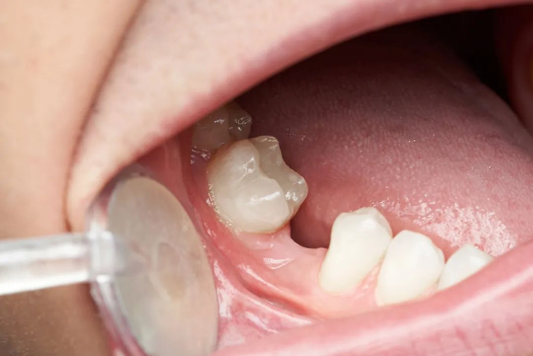牙龈萎缩还能做种植牙吗？深圳爱康健进口种植牙优惠低至2980元每颗！
