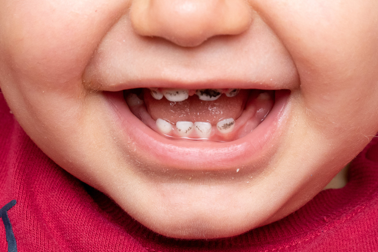 儿童牙齿的“黑点点”是什么？如何预防儿童蛀牙？