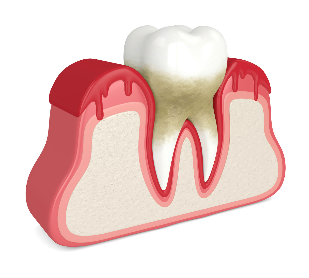 牙周炎的症状有哪些？如何预防牙周炎？