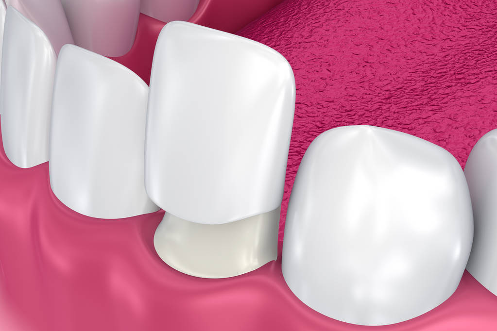 牙齿贴面有哪些种类？深圳牙齿贴面能报销吗？