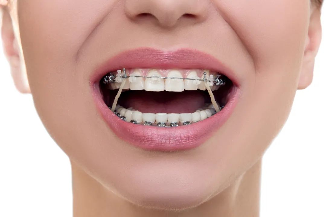 为什么戴牙套还要挂皮筋？深圳爱康健口腔牙齿矫正低至8800元！